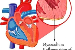 生死对决——危重暴发性心肌炎患者转危为安1例