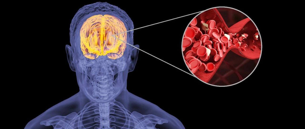 Stroke：大面积缺血性卒中取栓后再通次数与功能预后相关
