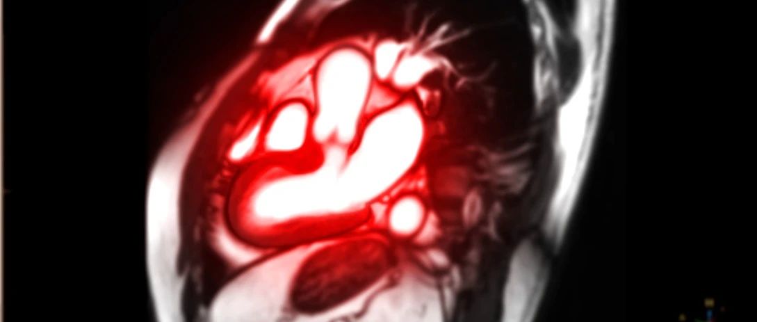JACC研究：两种新发现的主动脉狭窄生物标志物